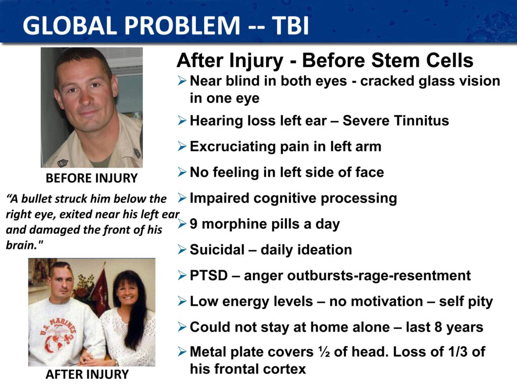 Traumatic brain injury before stem cell treatment
